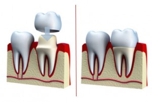 tandkroner ved tandlæger i odense karen juul